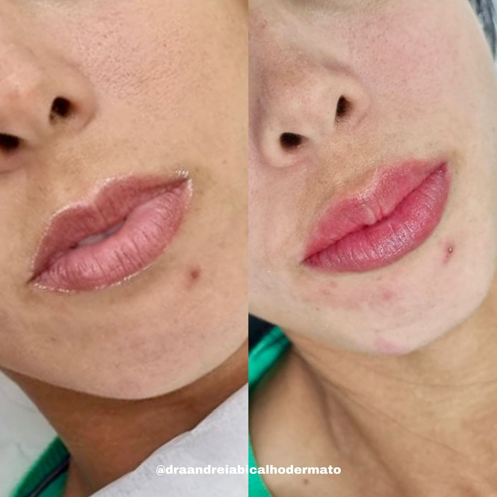 Resultado Improve Lip's Method 1