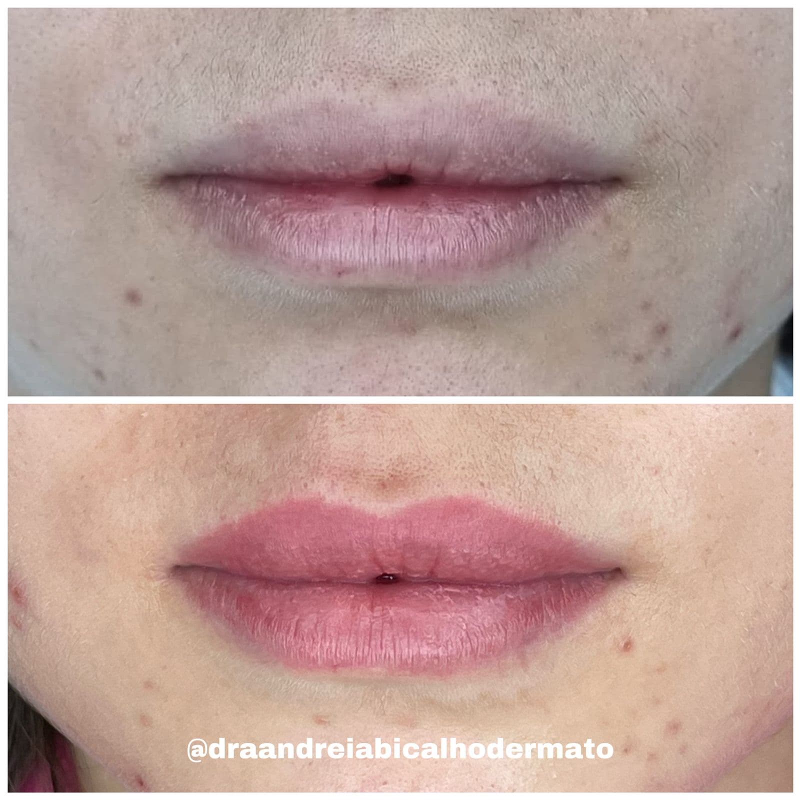 Resultado Improve Lip's Method 2