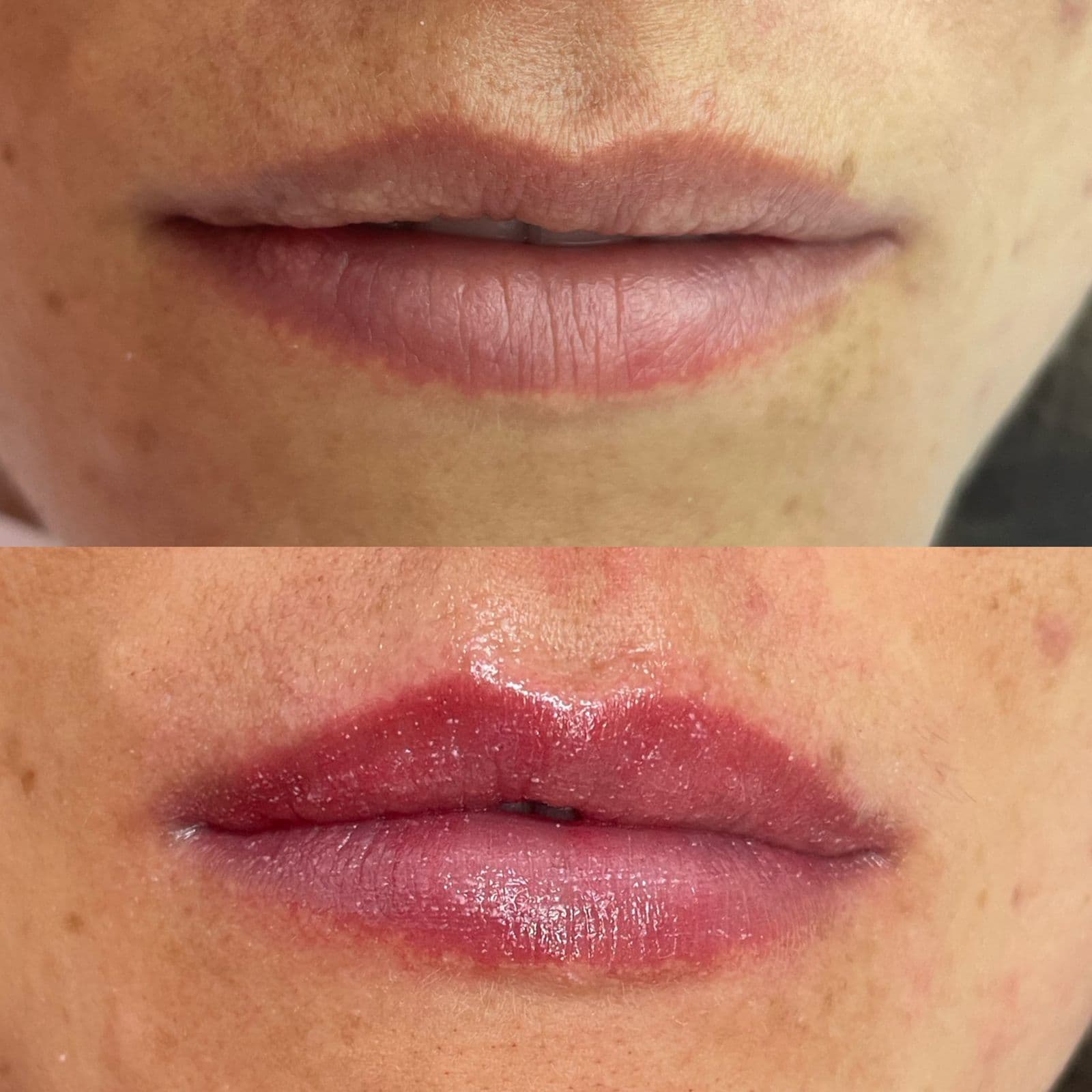Resultado Improve Lip's Method 3