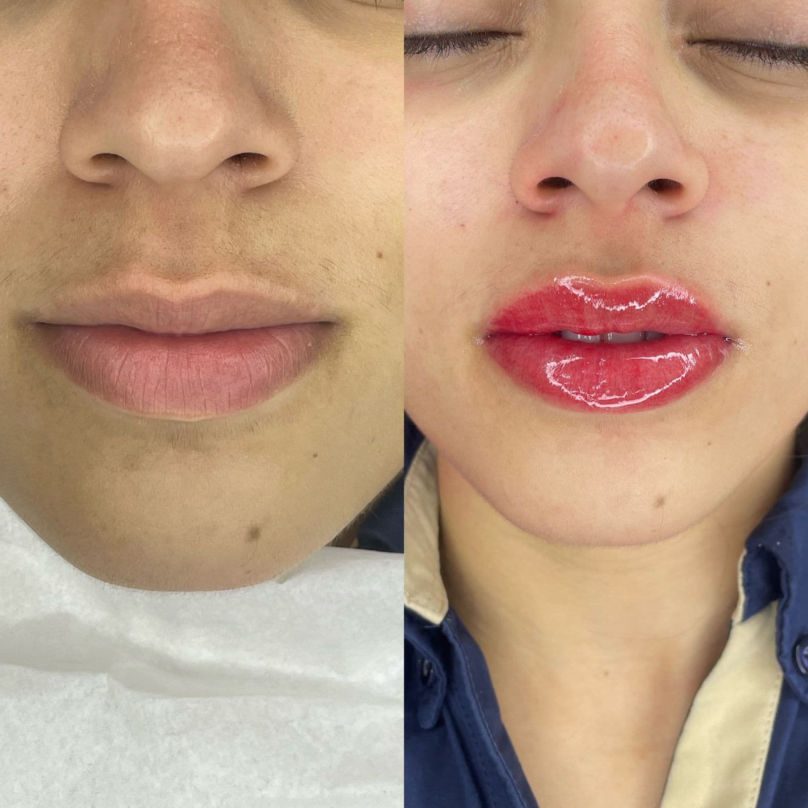 Resultado Improve Lip's Method 4