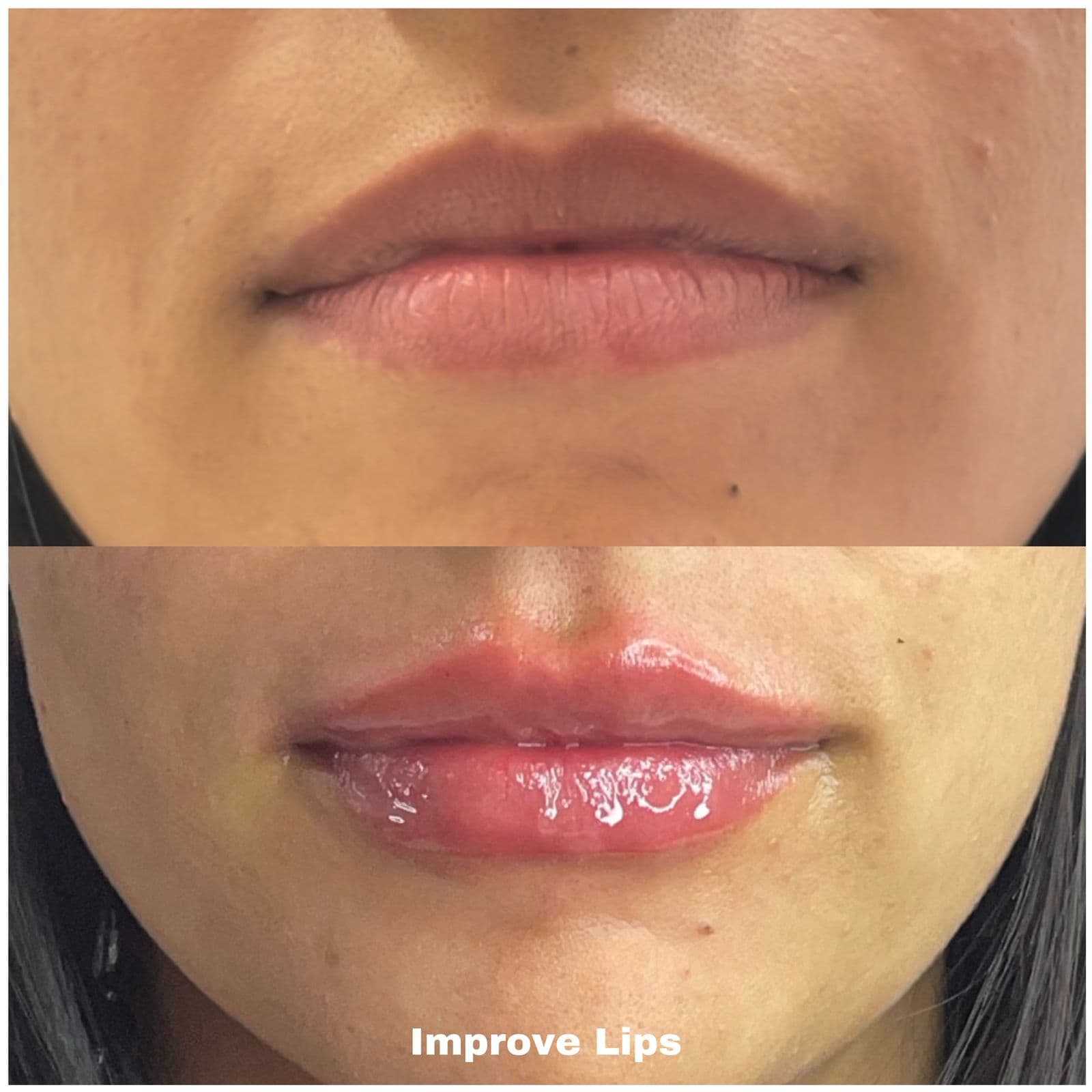 Resultado Improve Lip's Method 5