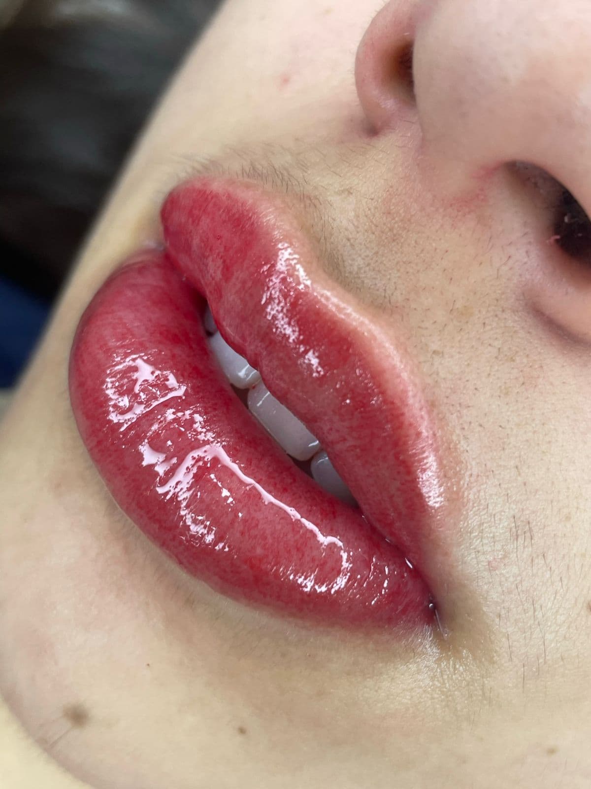 Resultado Improve Lip's Method 6