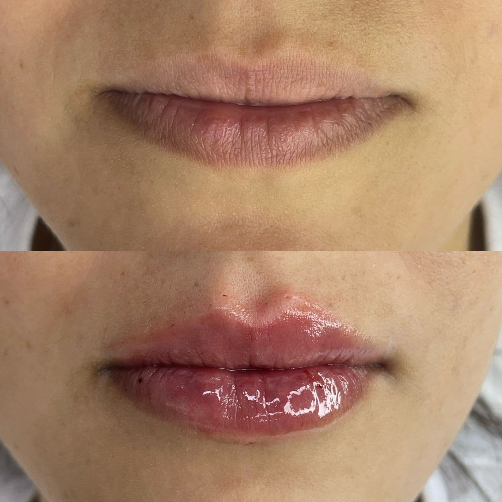 Resultado Improve Lip's Method 7