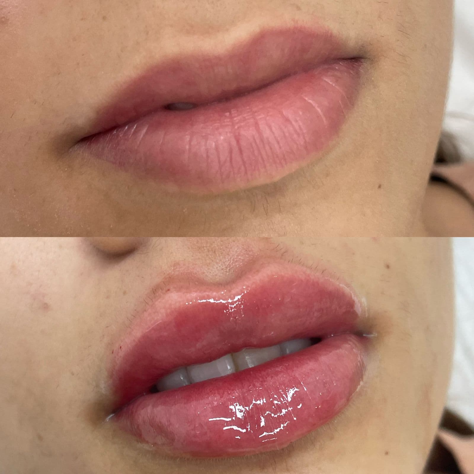 Resultado Improve Lip's Method 8