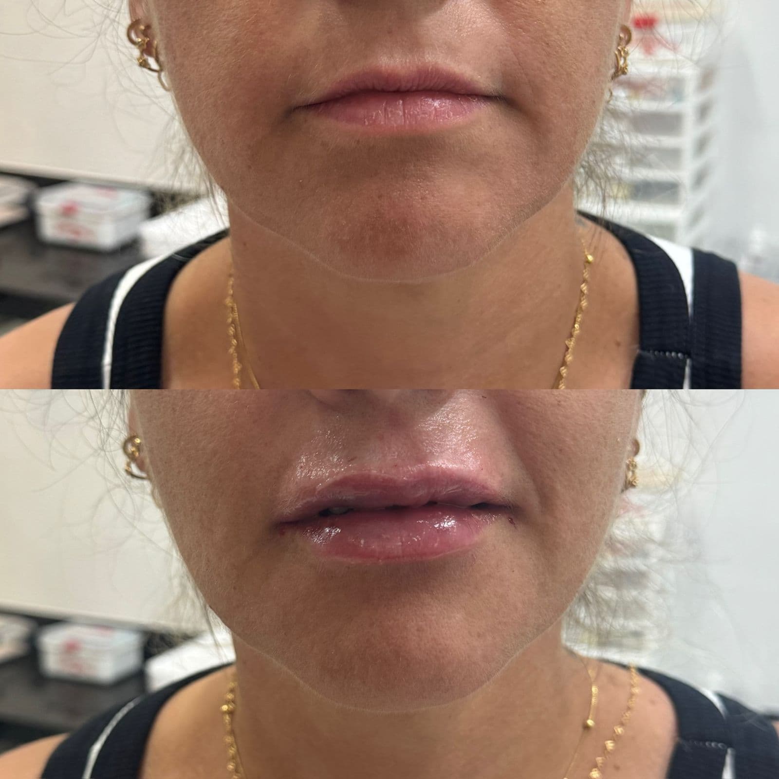 Resultado Improve Lip's Method 9