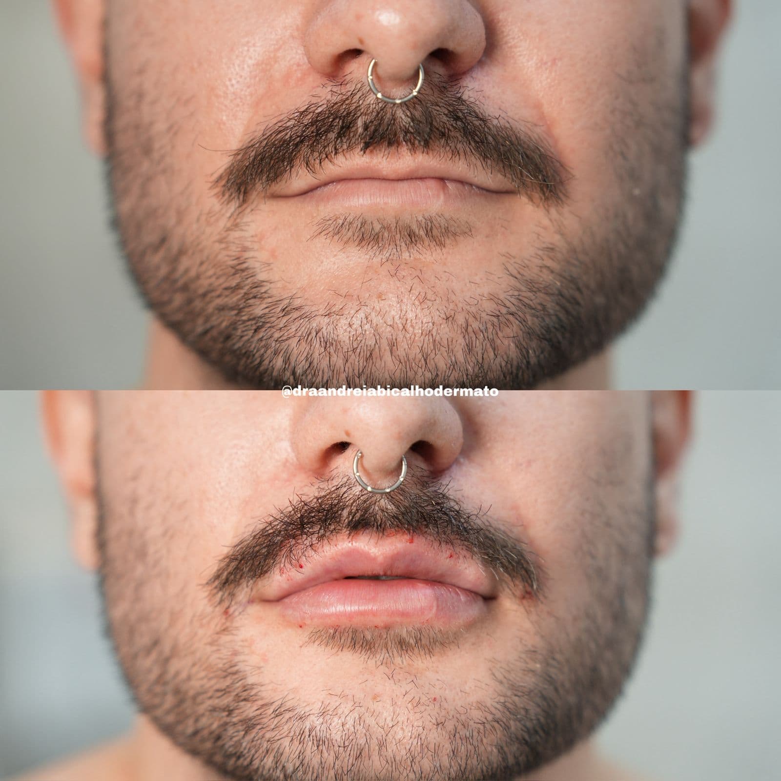 Resultado Improve Lip's Method 10