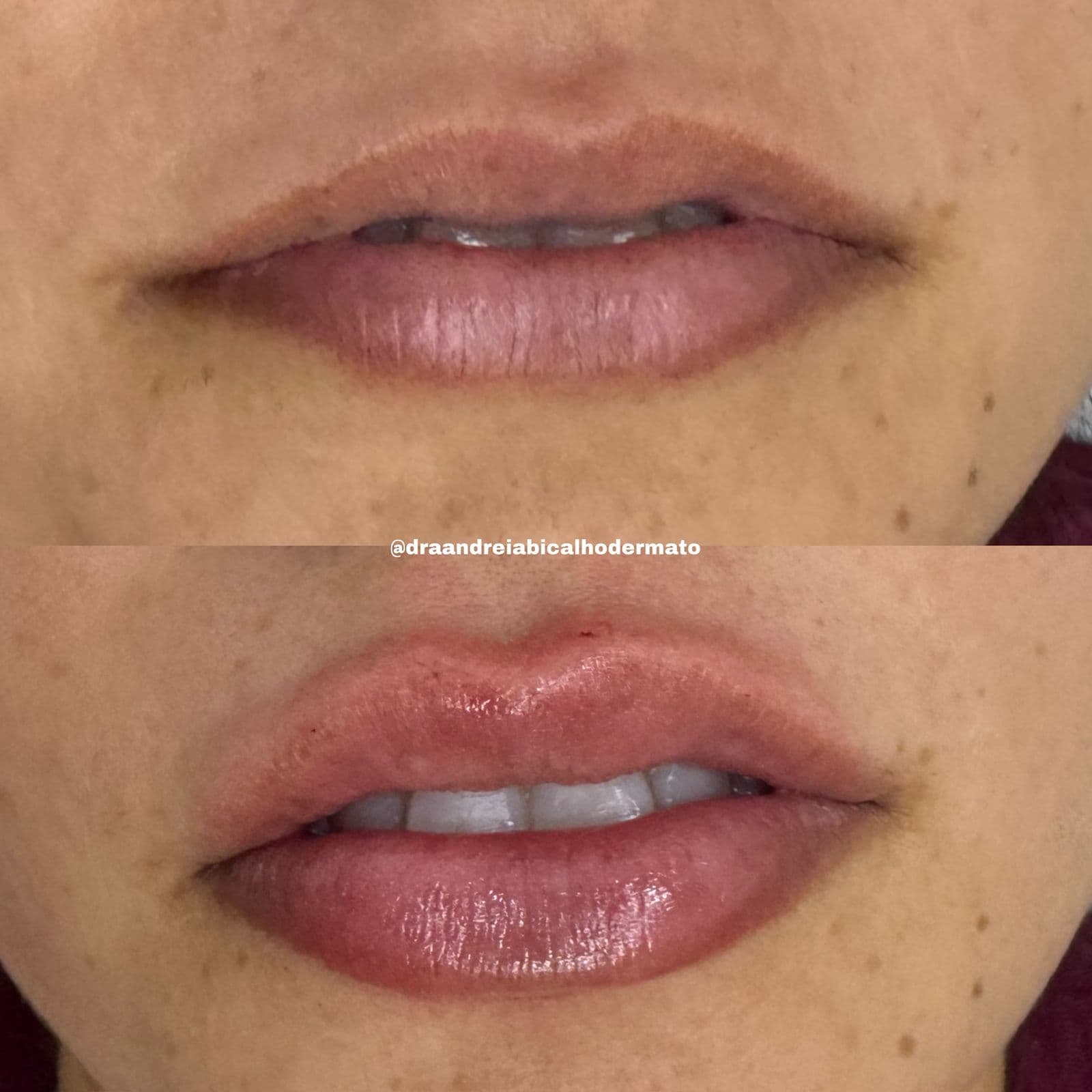 Resultado Improve Lip's Method 11