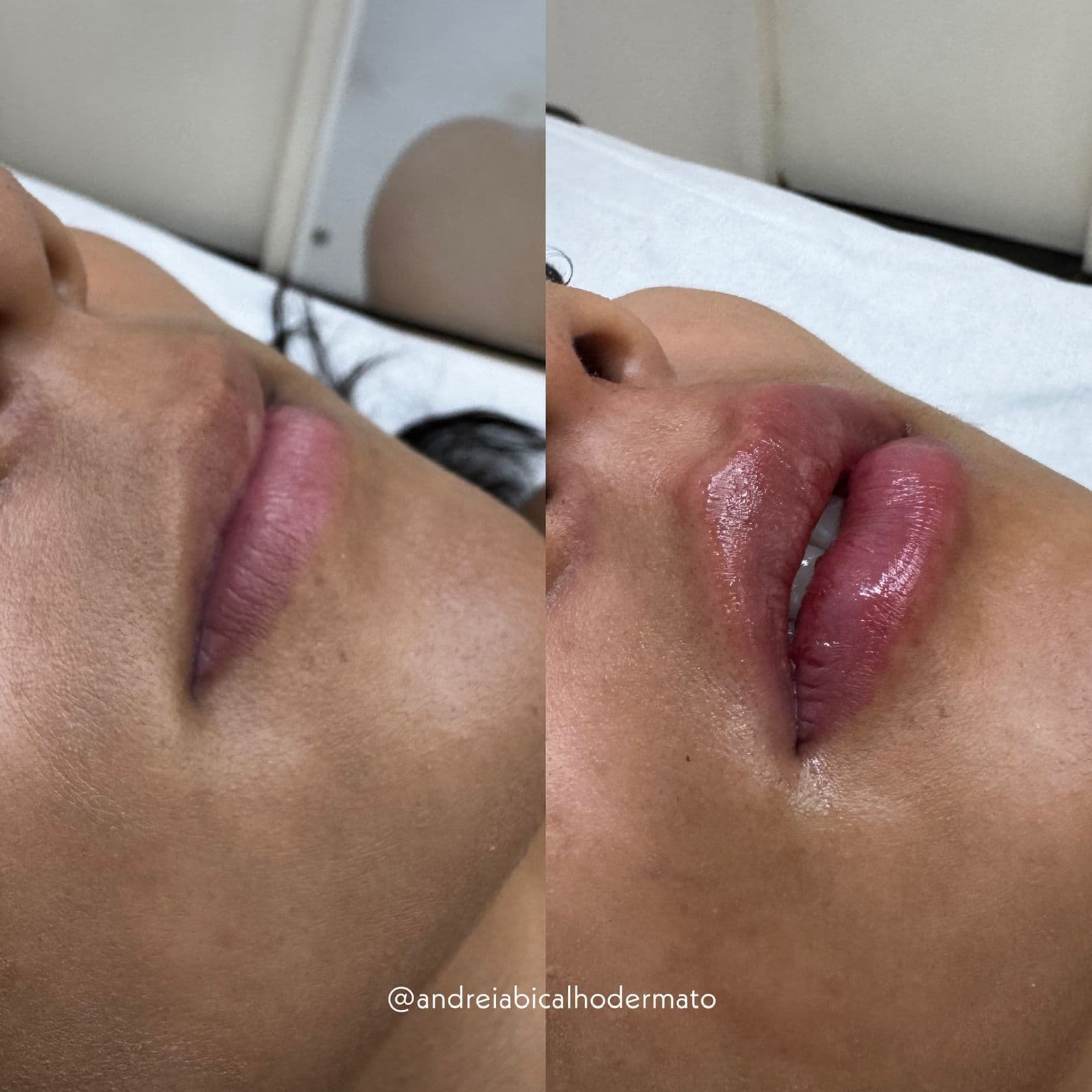 Resultado Improve Lip's Method 12