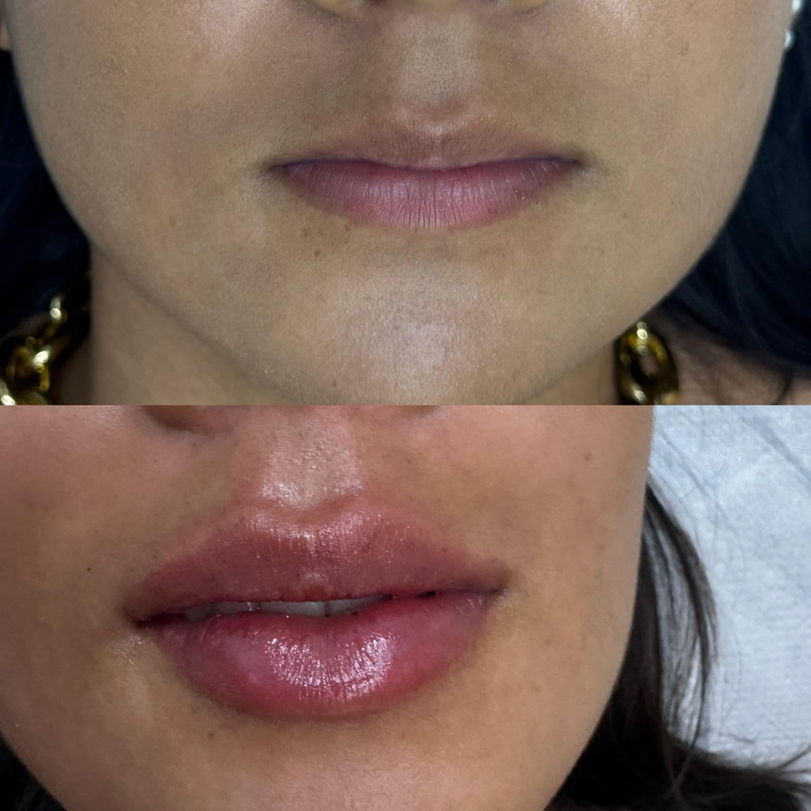 Resultado Improve Lip's Method 13