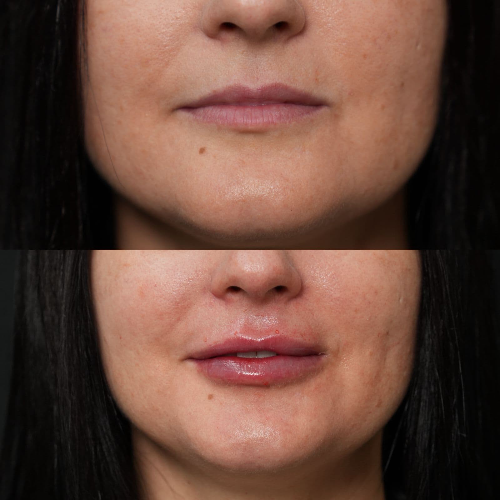 Resultado Improve Lip's Method 14